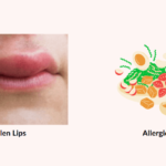 Swollen Lips Allergy Food | Causes | Symptoms| Diagnosis| Home Treatment