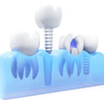 Why Should You Go for Affordable All on 4 Dental Implants?   