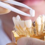 Get a Complete Oral Rehabilitation with All on 4 Dental Implants
