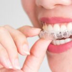 4 Ways to Take Care of Your Invisalign Clear Aligners