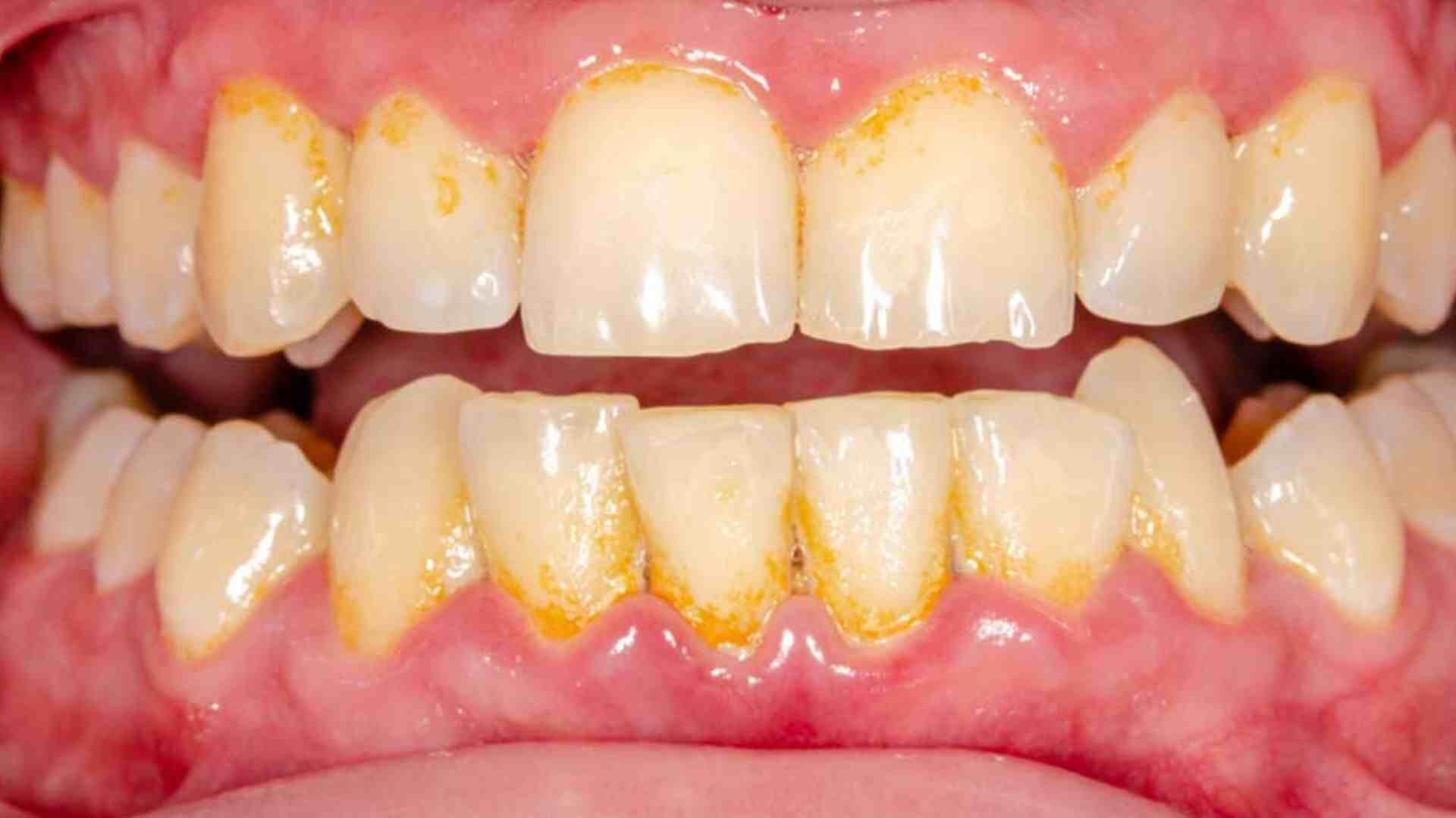 How To Remove Tartar From Teeth Without Dentist? 3 HACKS