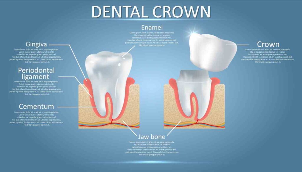 Dental Crowns Or Filling